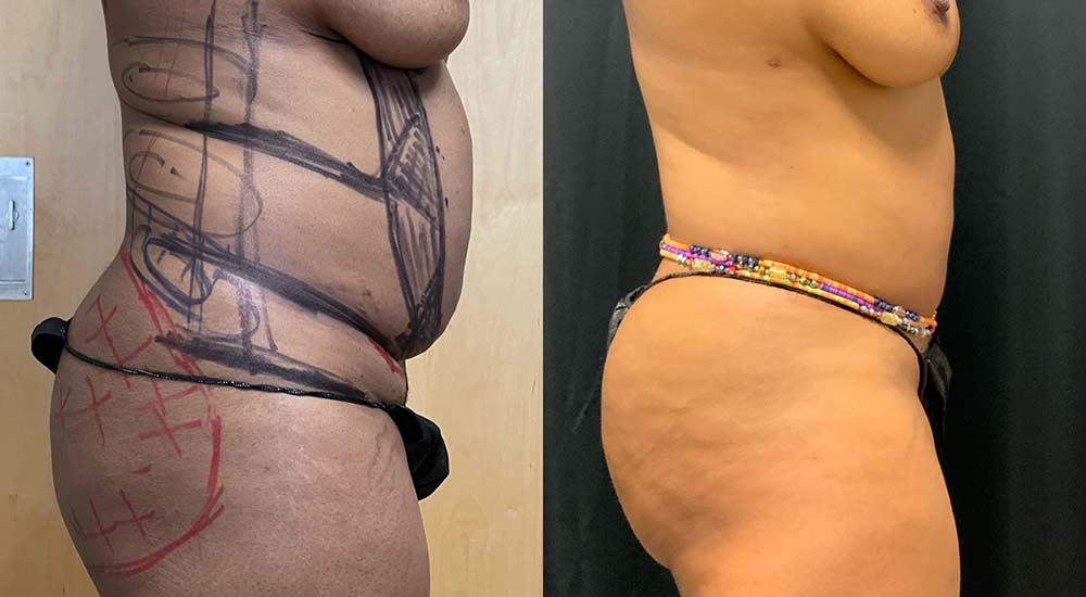 Vaser Liposuction Before & After Image