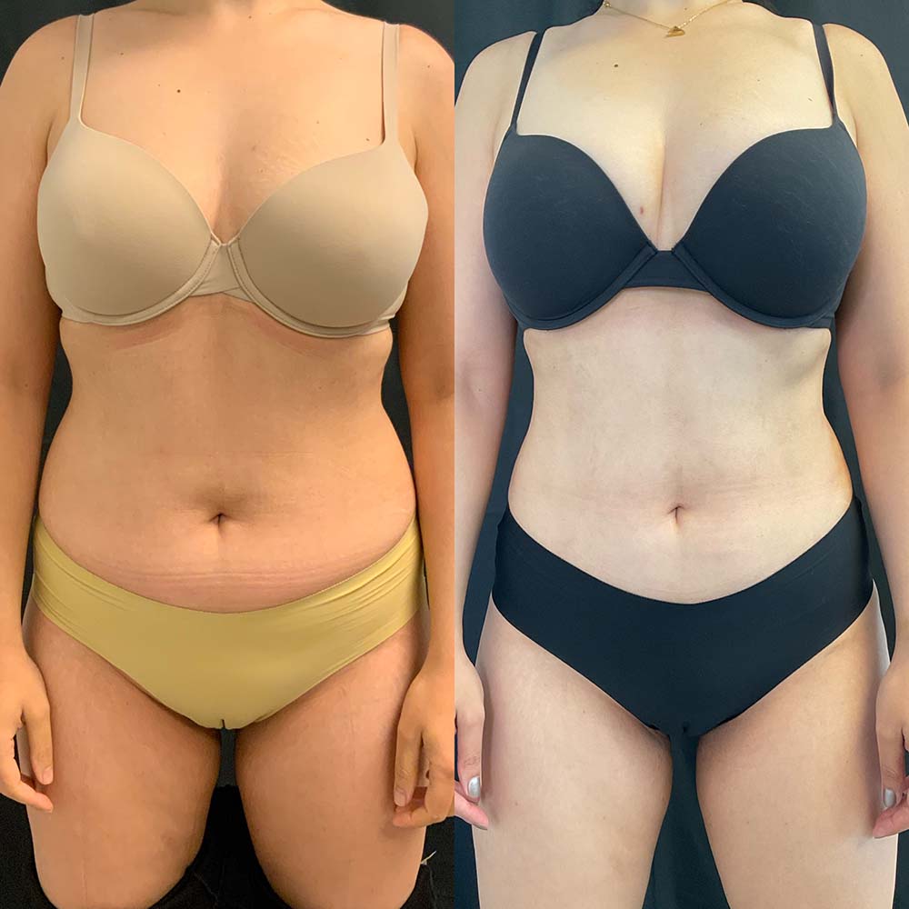 Vaser Liposuction Before & After Image