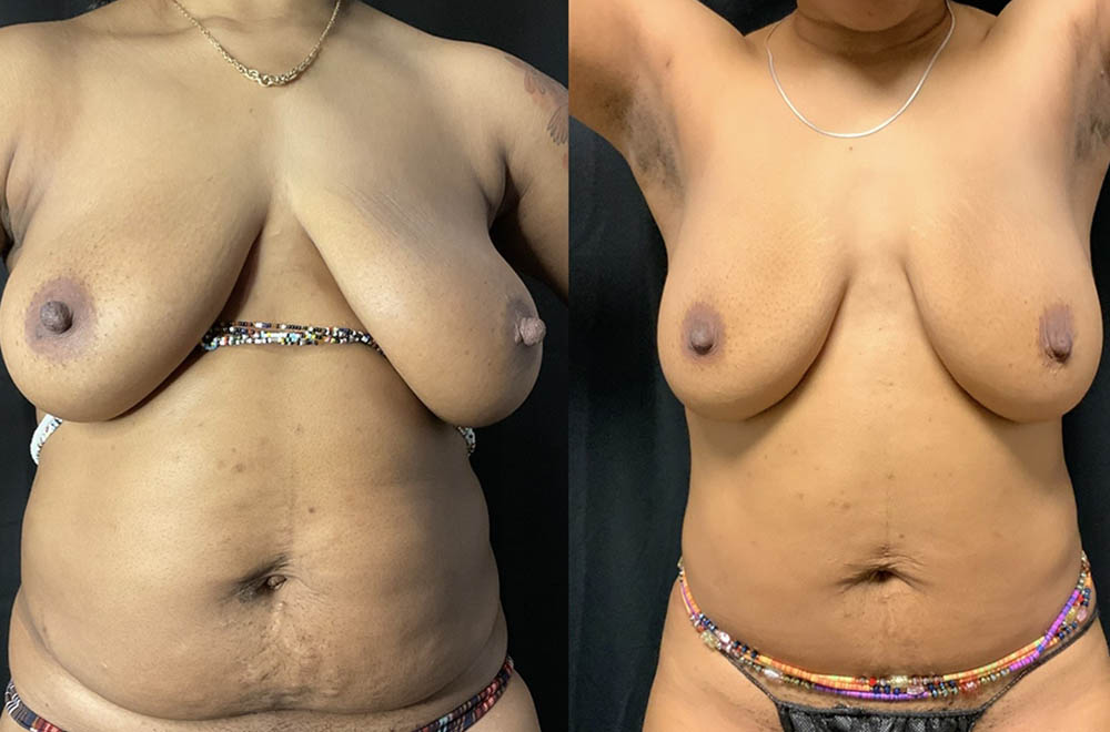 Vaser Liposuction Before & After Image