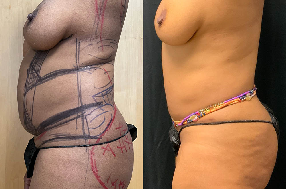 Vaser Liposuction Before & After Image