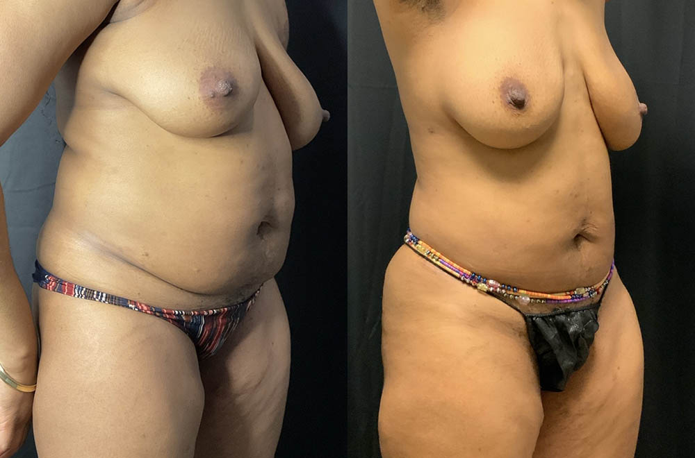 Vaser Liposuction Before & After Image