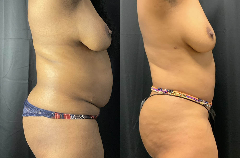 Vaser Liposuction Before & After Image