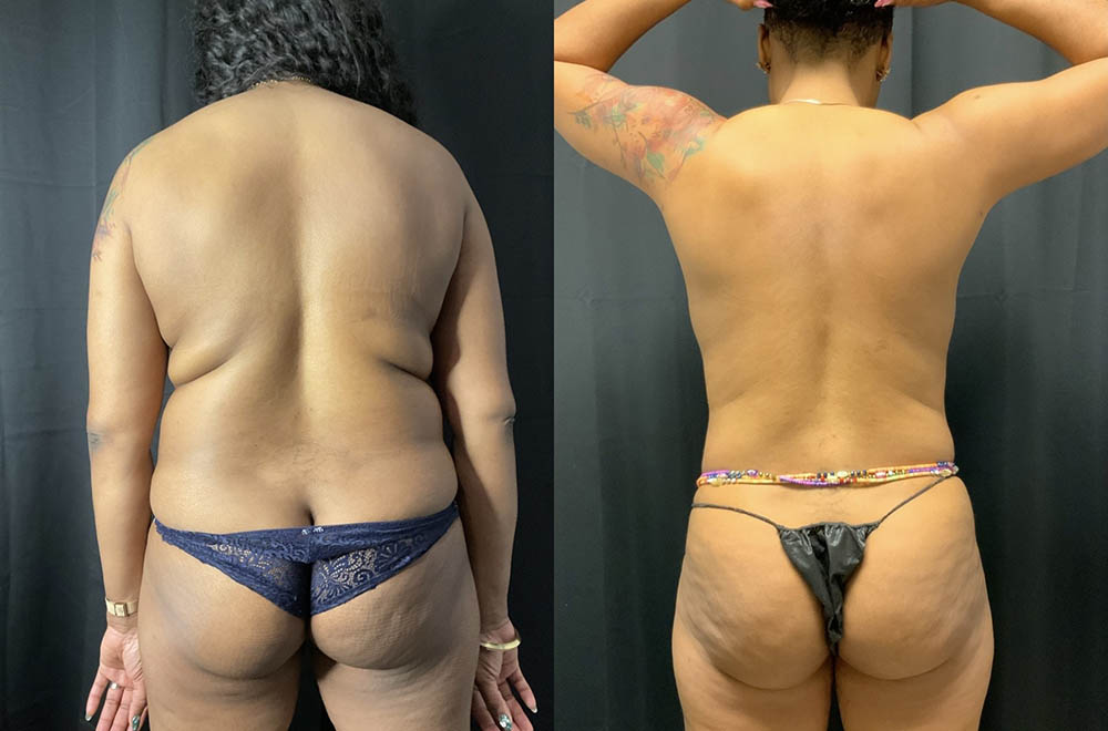 Vaser Liposuction Before & After Image