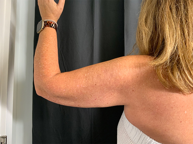 Arm Liposuction Before & After Image