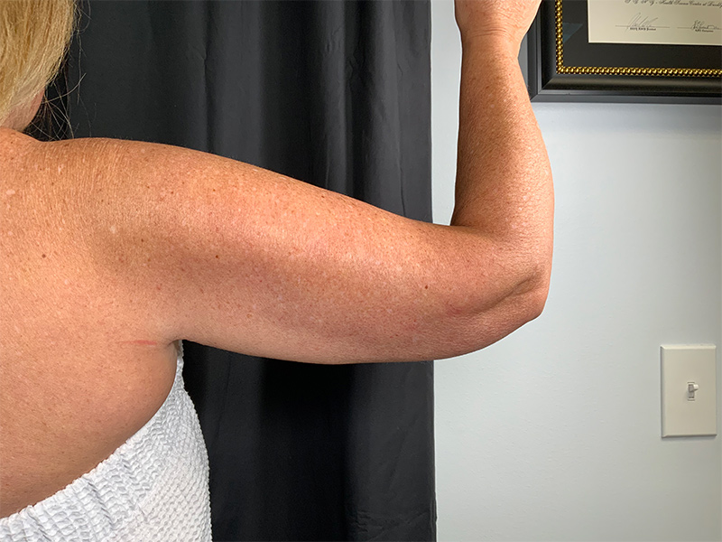 Arm Liposuction Before & After Image