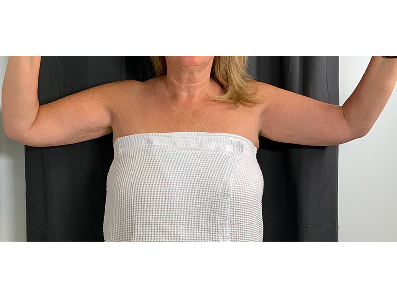 Arm Liposuction Before & After Image