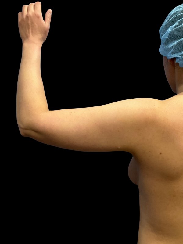 Arm Liposuction Before & After Image