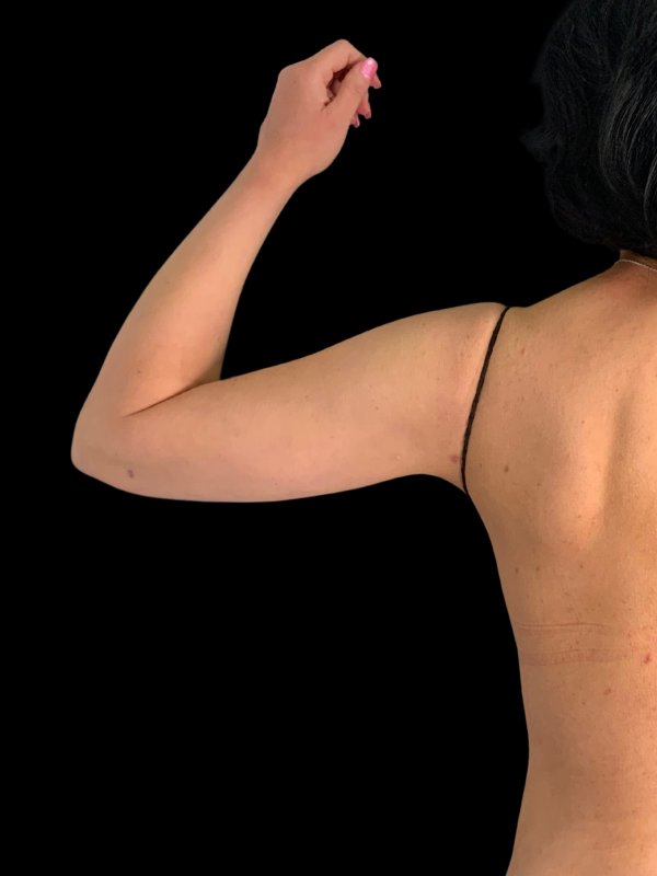 Arm Liposuction Before & After Image