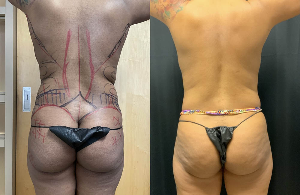 Back Liposuction Before & After Image