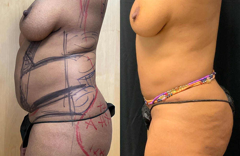 Back Liposuction Before & After Image