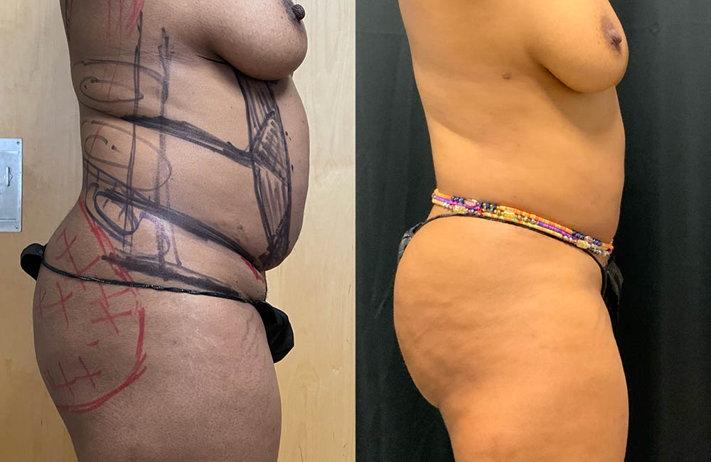 Back Liposuction Before & After Image