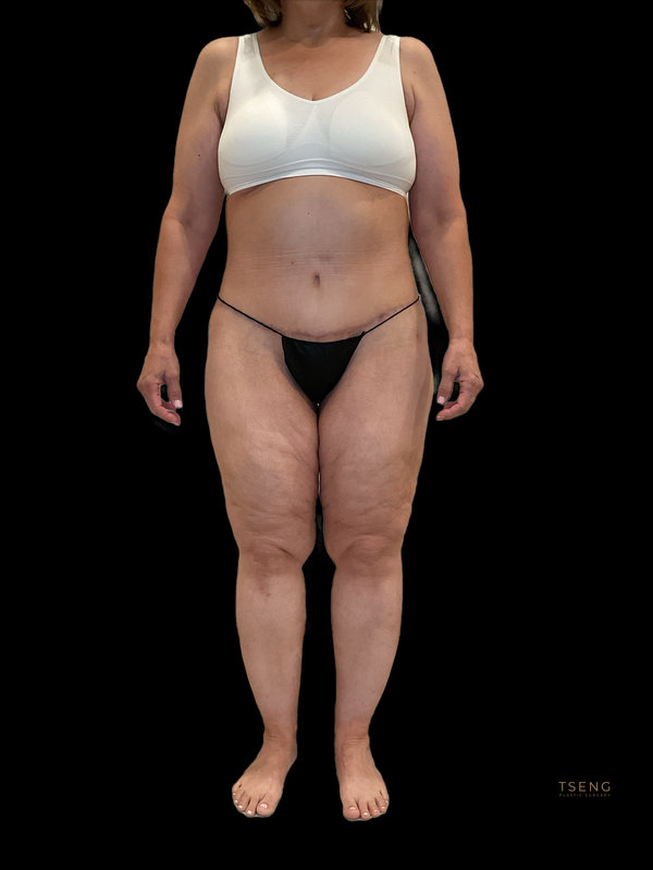 Liposuction & Body Lift Before & After Image