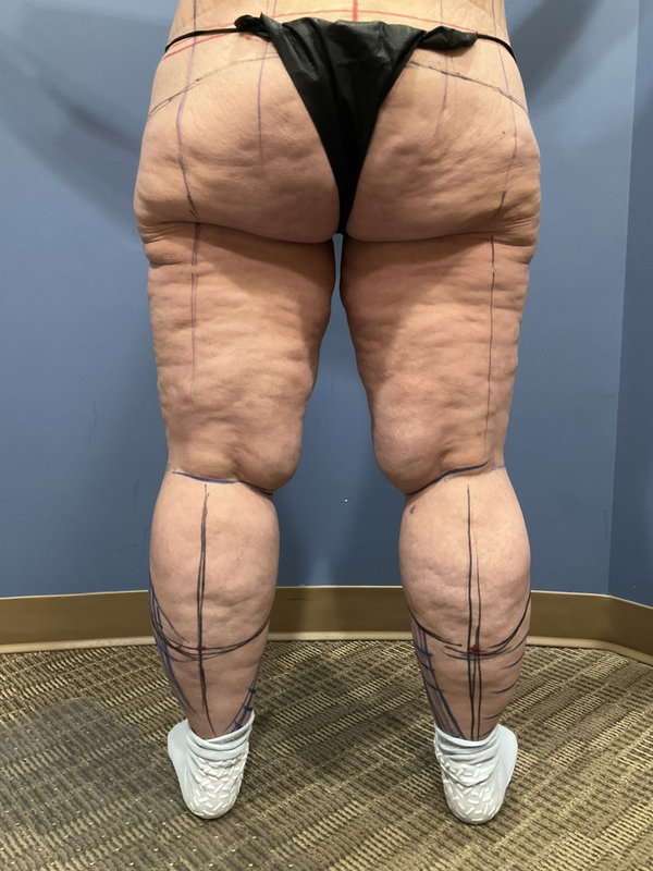 Liposuction & Body Lift Before & After Image