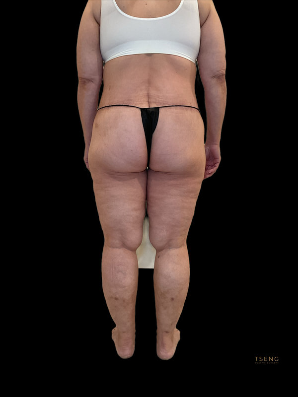 Liposuction & Body Lift Before & After Image