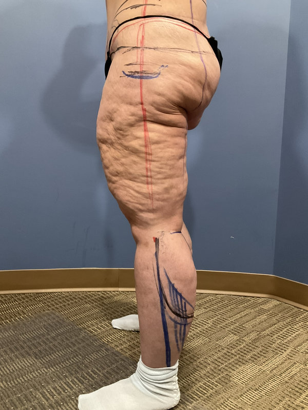 Liposuction & Body Lift Before & After Image