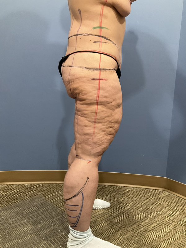 Liposuction & Body Lift Before & After Image