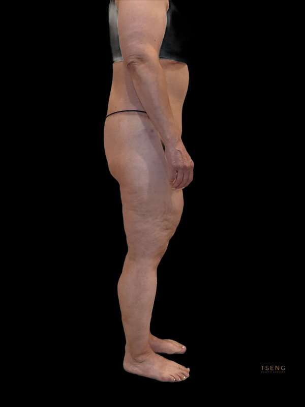 Liposuction & Body Lift Before & After Image
