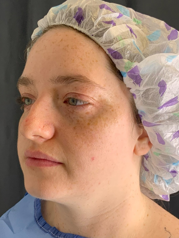 Chin Liposuction Before & After Image
