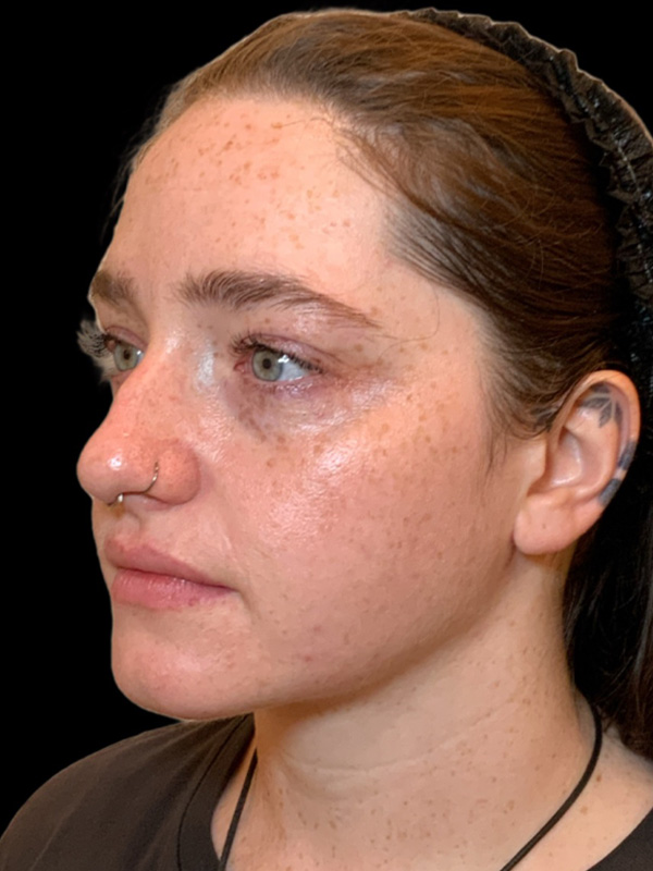 Chin Liposuction Before & After Image