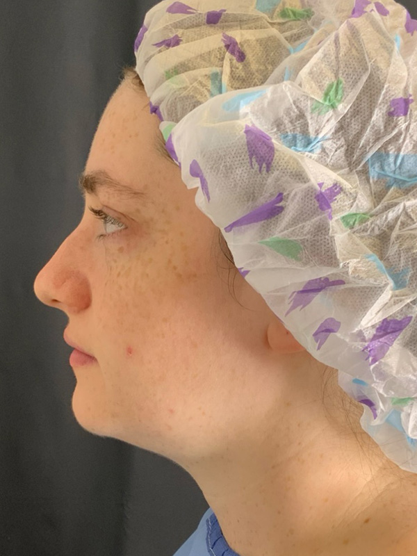 Chin Liposuction Before & After Image