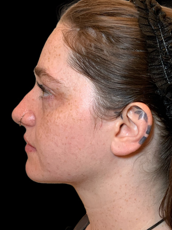 Chin Liposuction Before & After Image