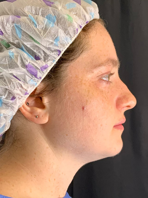 Chin Liposuction Before & After Image
