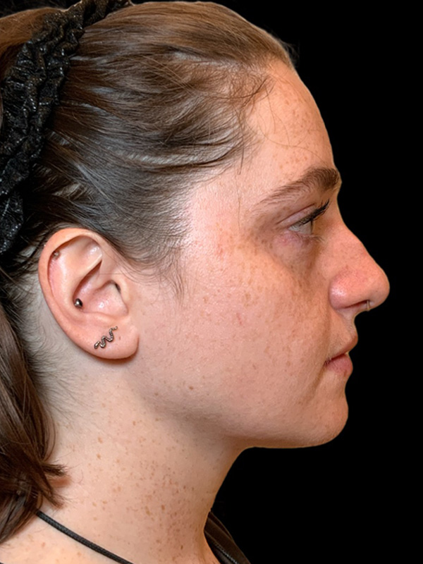 Chin Liposuction Before & After Image