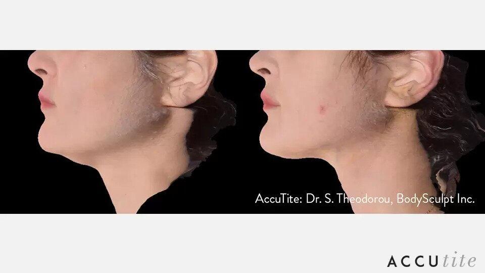 AccuTite Before & After Image