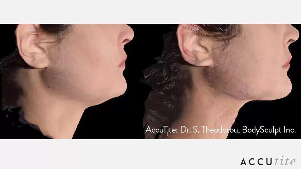 AccuTite Before & After Image