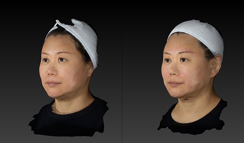 AccuTite Before & After Image