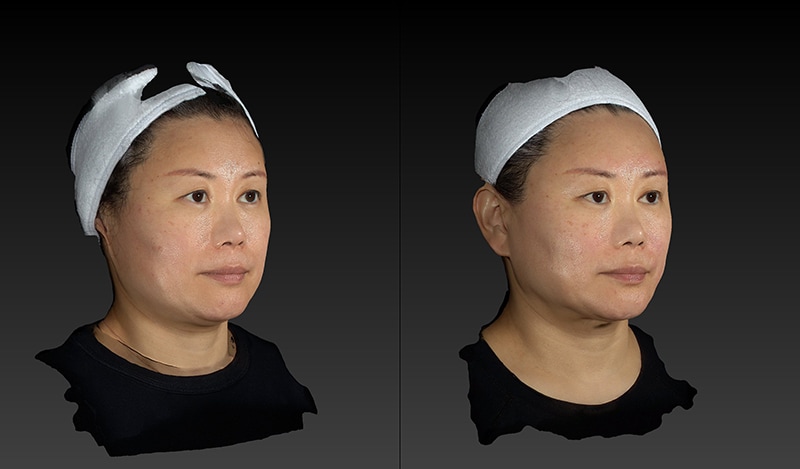 AccuTite Before & After Image