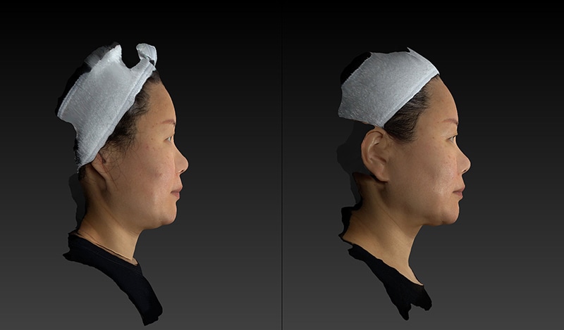 AccuTite Before & After Image