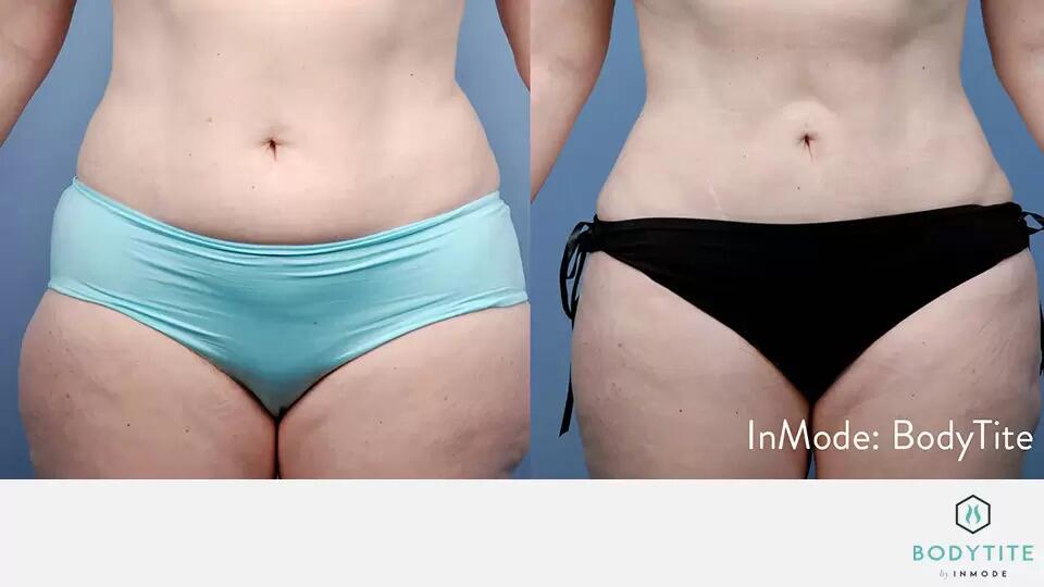 Body Sculpting Before & After Image