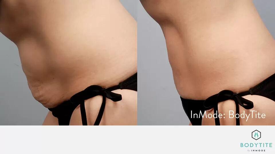 Body Sculpting Before & After Image