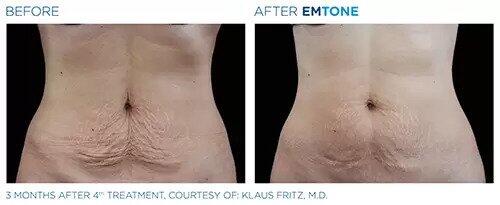 EmTone Before & After Image