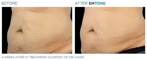 EmTone Before & After Image