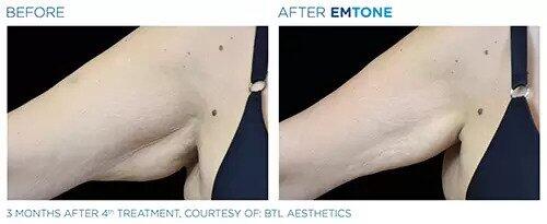 EmTone Before & After Image