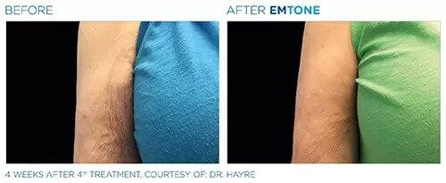 EmTone Before & After Image