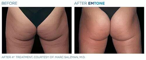 EmTone Before & After Image