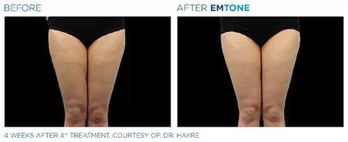 EmTone Before & After Image