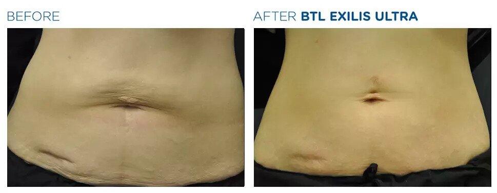 Exilis Ultra Before & After Image