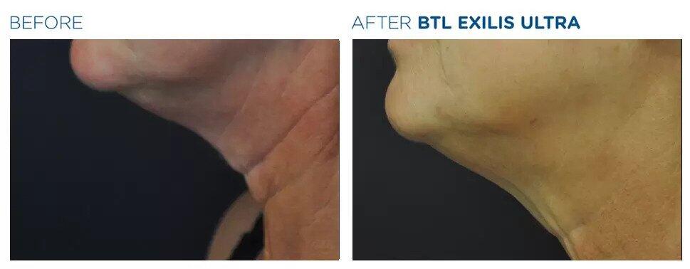 Exilis Ultra Before & After Image