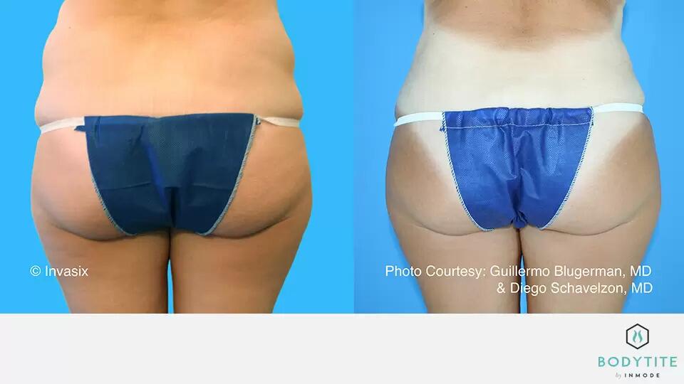 HD Liposuction Body Sculpting Before & After Image