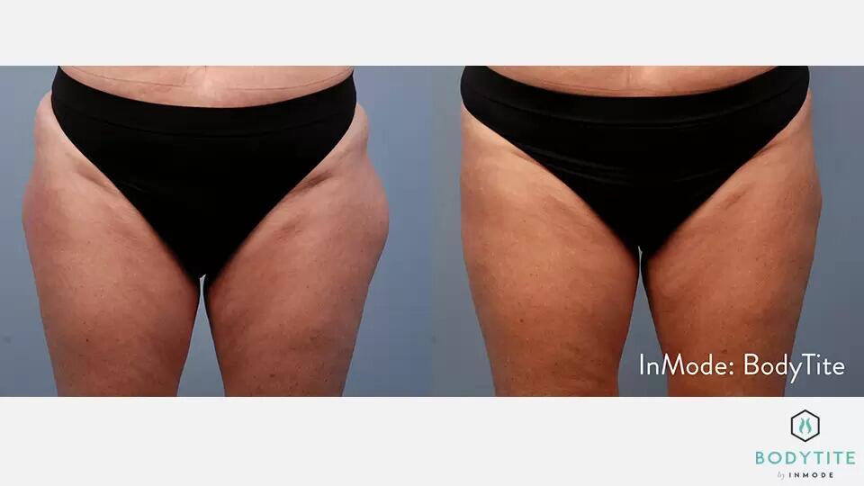 HD Liposuction Body Sculpting Before & After Image