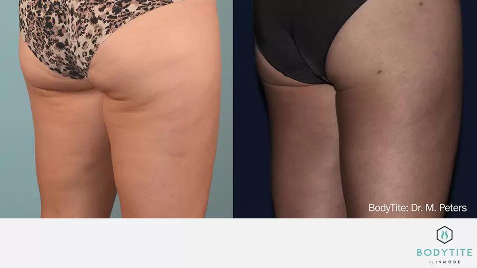 HD Liposuction Body Sculpting Before & After Image