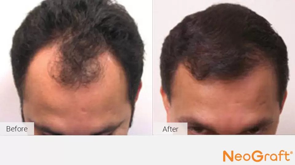 NeoGraft Before & After Image