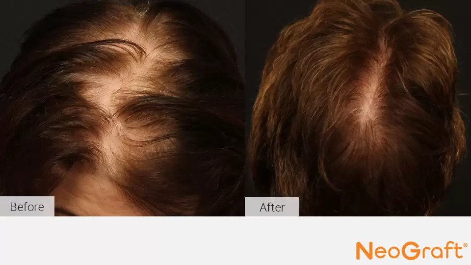 NeoGraft Before & After Image